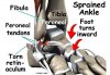 ankle_peroneal_sublux_causes03.jpg
